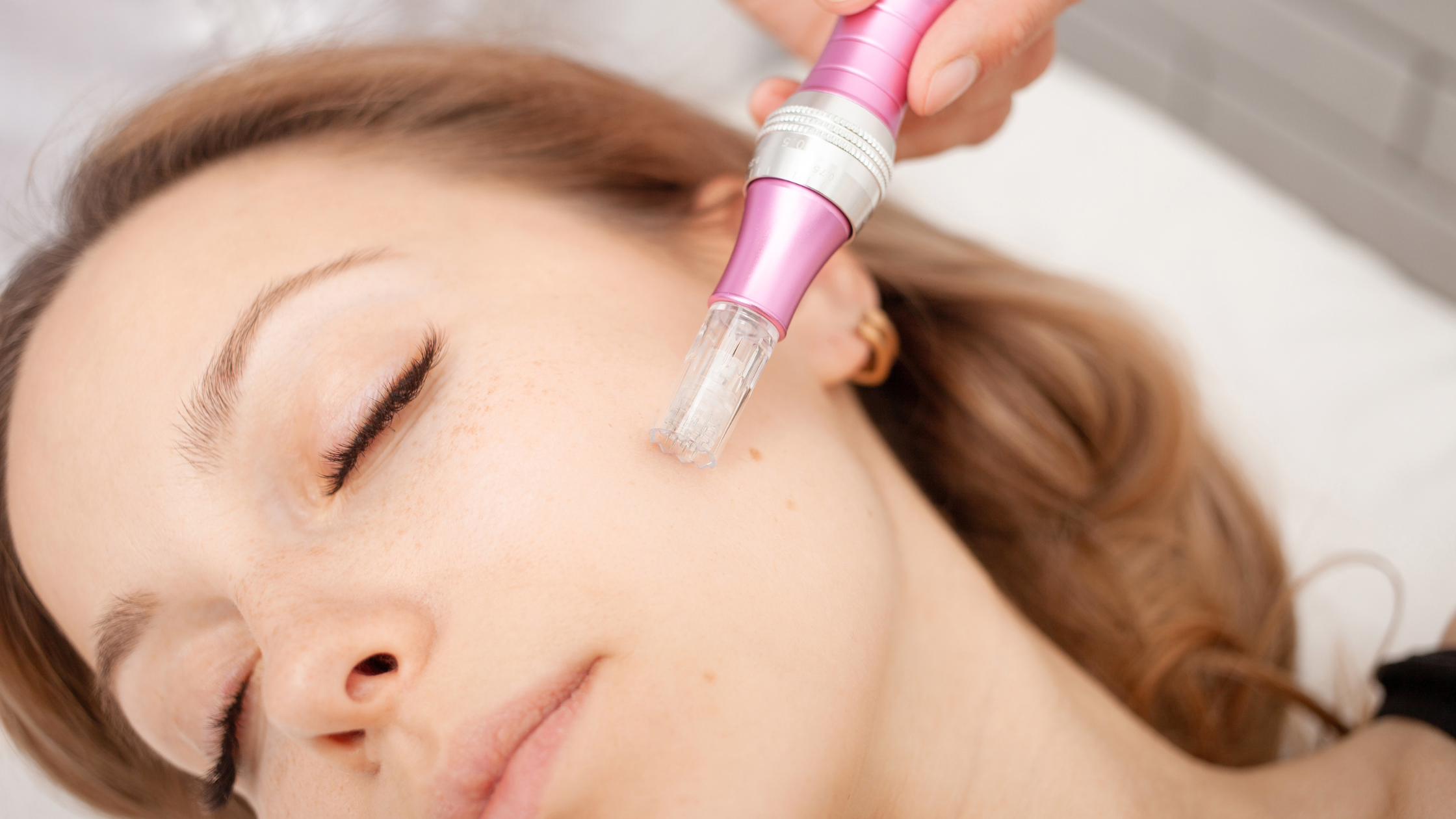 The 411 on Microneedling